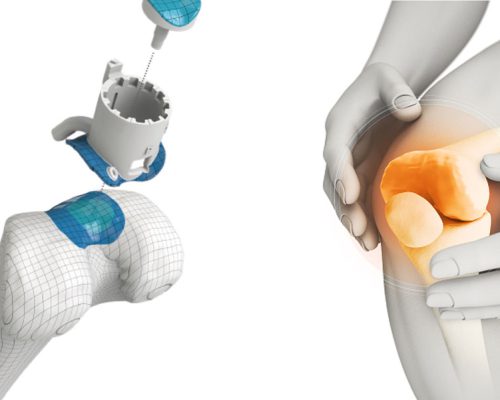 p_KNEE-IMPLANTS p_KNEE-IMPLANTS